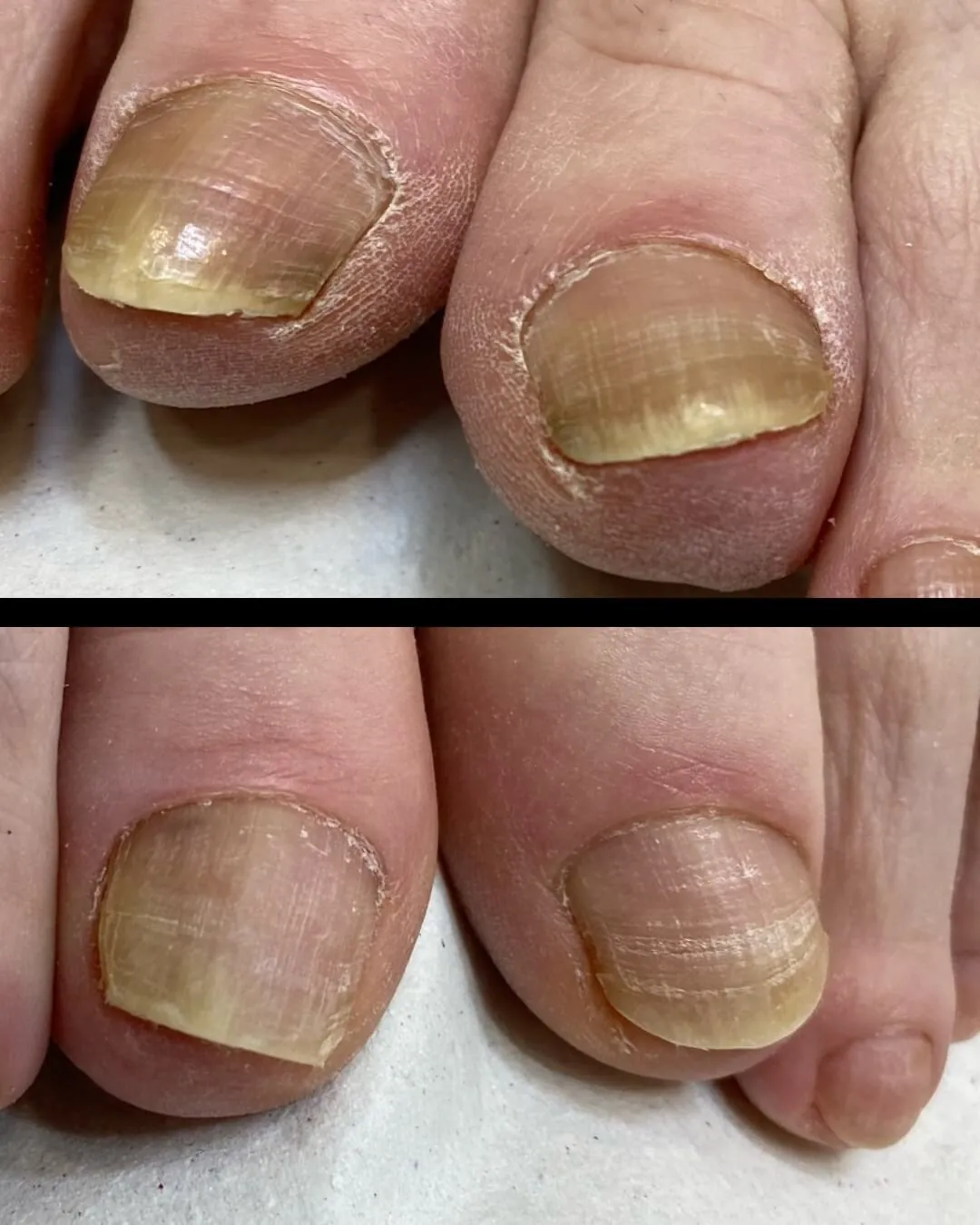 Tratamiento Onicomicosis de las uñas de los pies