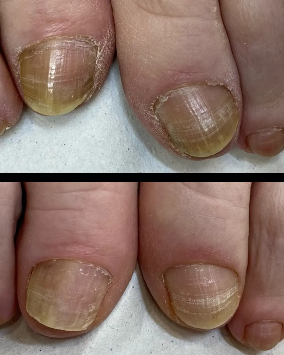 Eliminación hongos de las uñas de los pies con láser