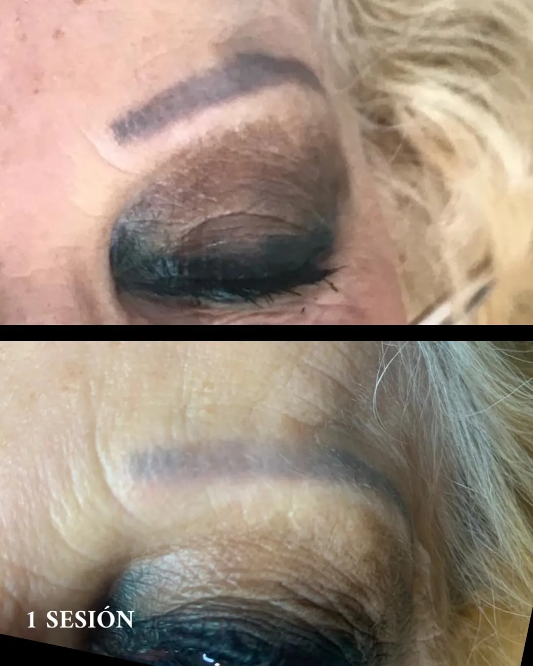 Eliminación micropigmentaciones de cejas en Valencia