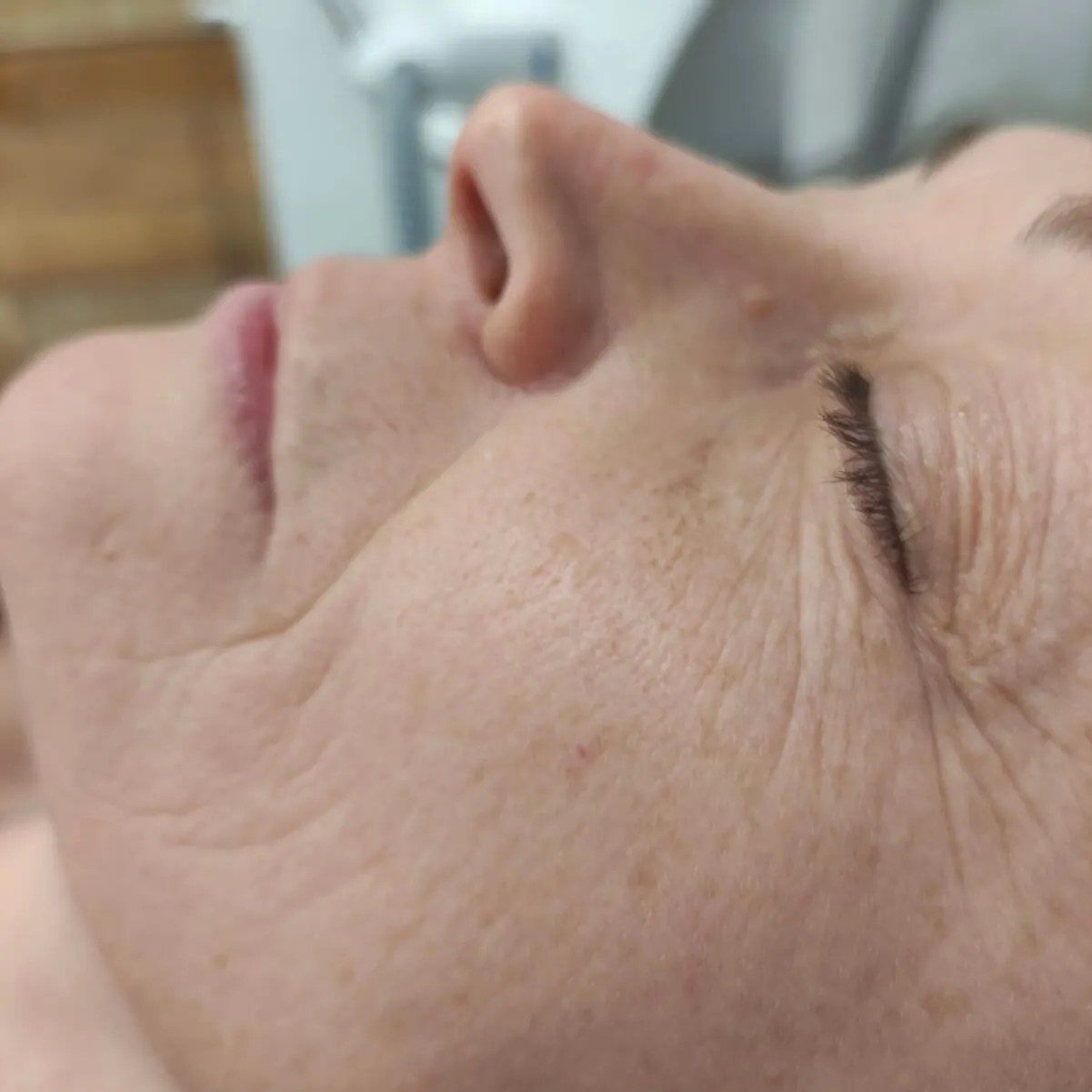 Tratamiento Hollywood Peel antes de tratamiento