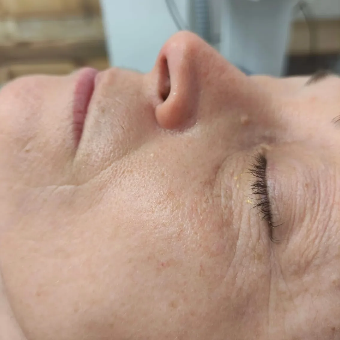 Tratamiento Hollywood Peel después de tratamiento