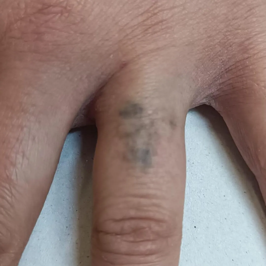 Eliminación tatuaje lazo en el dedo en su segunda sesión