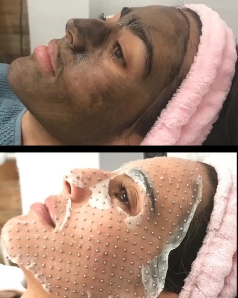 Mascarilla de carbón activo y mascarilla facial durante un tratamiento Hollywood Peel