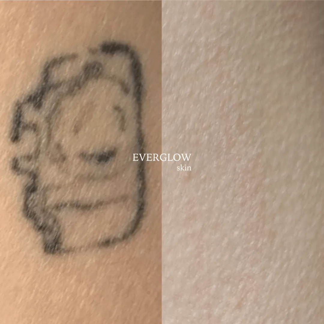 Elimina tu tatuaje sin dolor con nuestro tratamiento láser