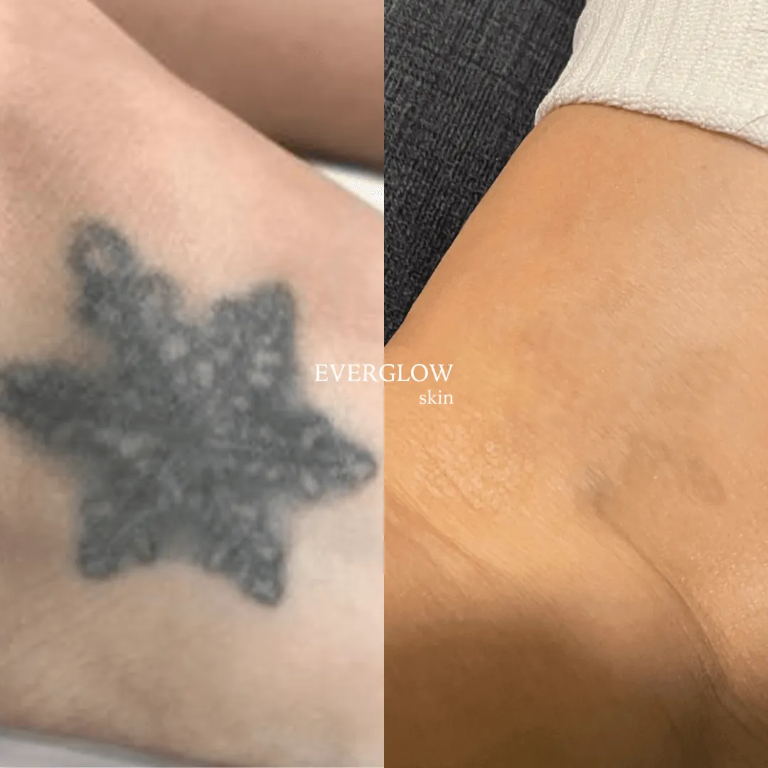El mejor tratamiento láser para borrar tatuajes en Valencia