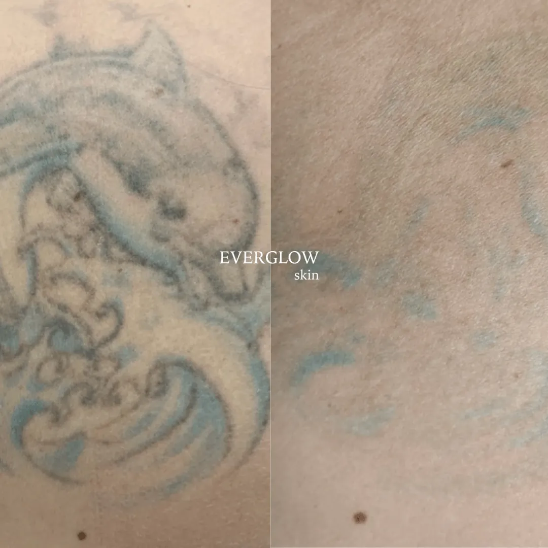 Tecnología láser avanzada para borrar tatuajes en Valencia