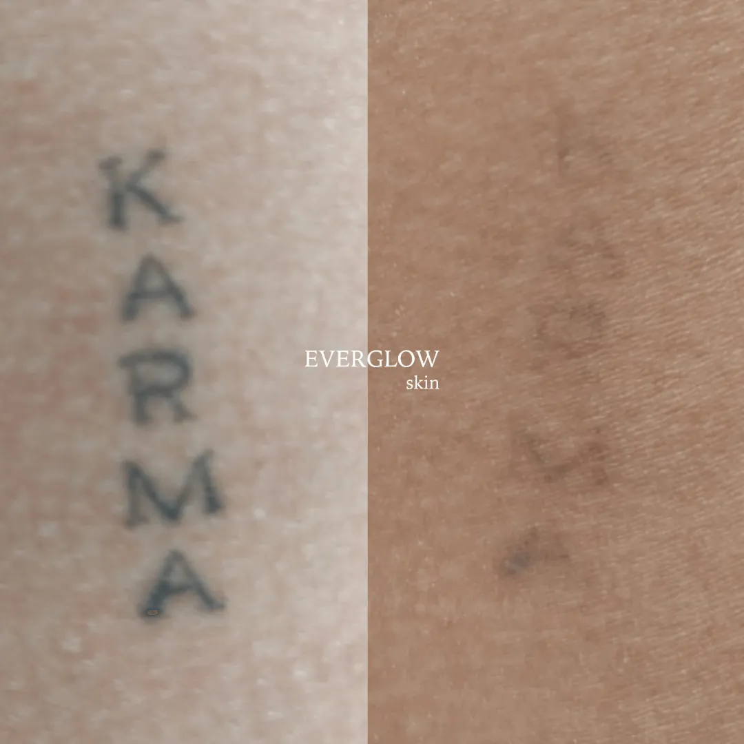 Cómo eliminar un tatuaje de forma segura y eficaz
