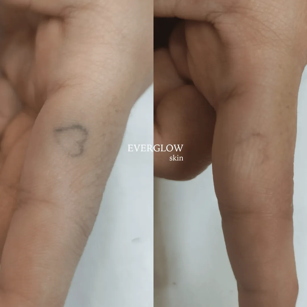 Centro especializado en eliminación de tatuajes en Valencia