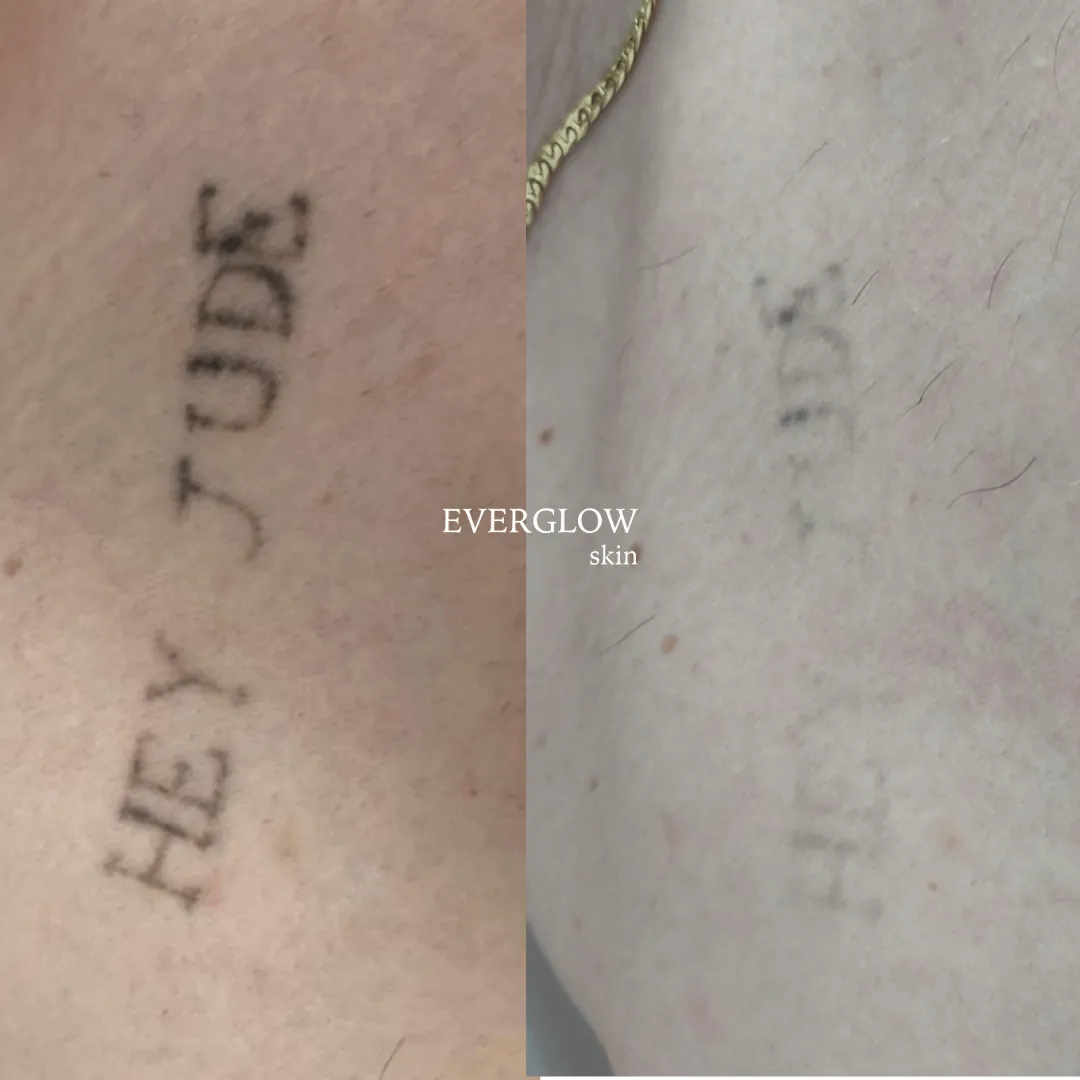 Antes y después de eliminar un tatuaje con láser
