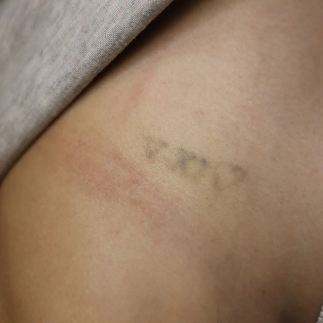 Eliminación tatuaje romano Tercera sesión
