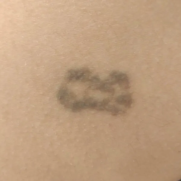 Eliminación de tatuaje de Andrea Garte en su cuarte sesión