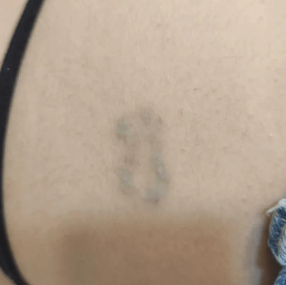 8ºsesión ANDREA GARTE Eliminación tatuajes valencia