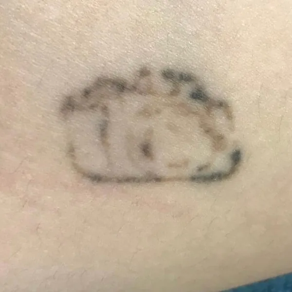 Eliminación tatuaje brazo Andrea Garte primera sesión