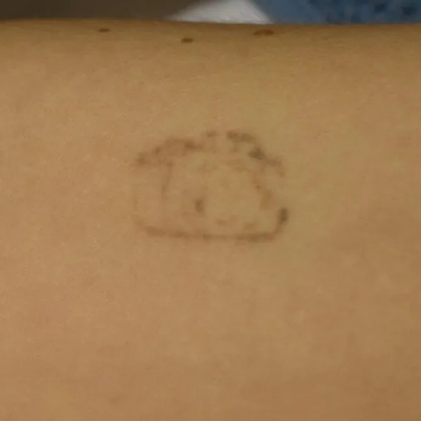 Tercera sesión eliminación de tatuaje Brazo Andrea Garte