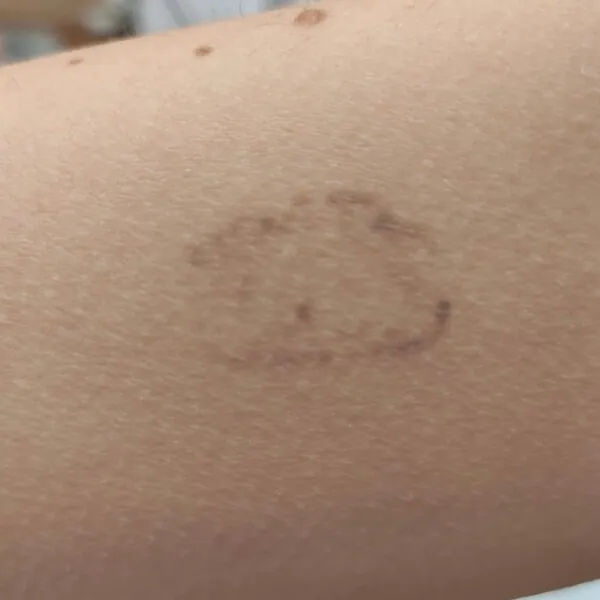 Eliminación de tatuaje del brazo de Andrea Garte en su cuarte sesión