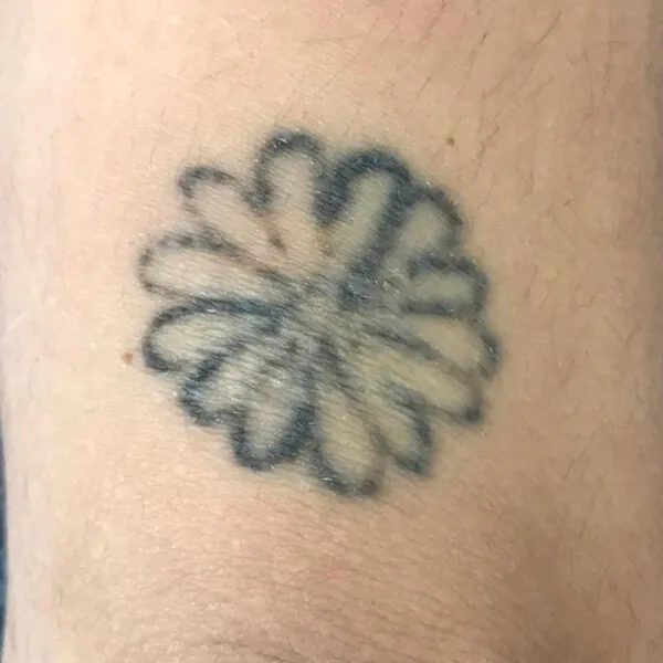 Eliminación tatuaje antebrazo Andrea Garte primera sesión