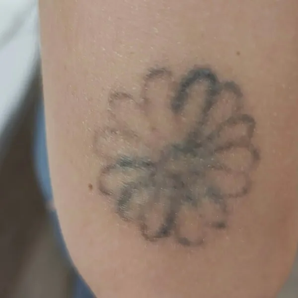 Eliminación de tatuaje del ante brazo de Andrea Garte en su cuarte sesión