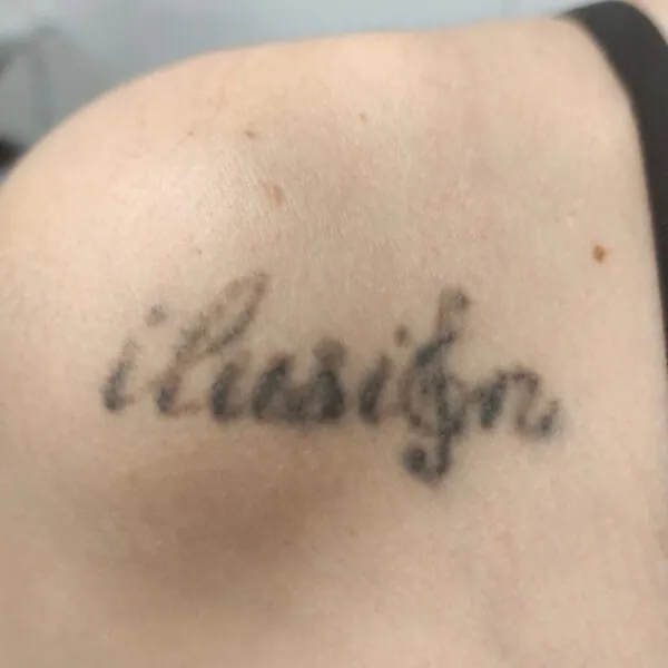 Eliminación de tatuaje del hombro de Andrea Garte en su cuarte sesión
