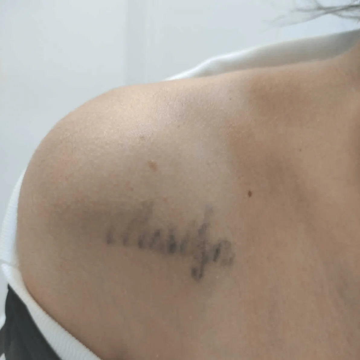 6ºsesión ANDREA GARTE Eliminación tatuajes valencia