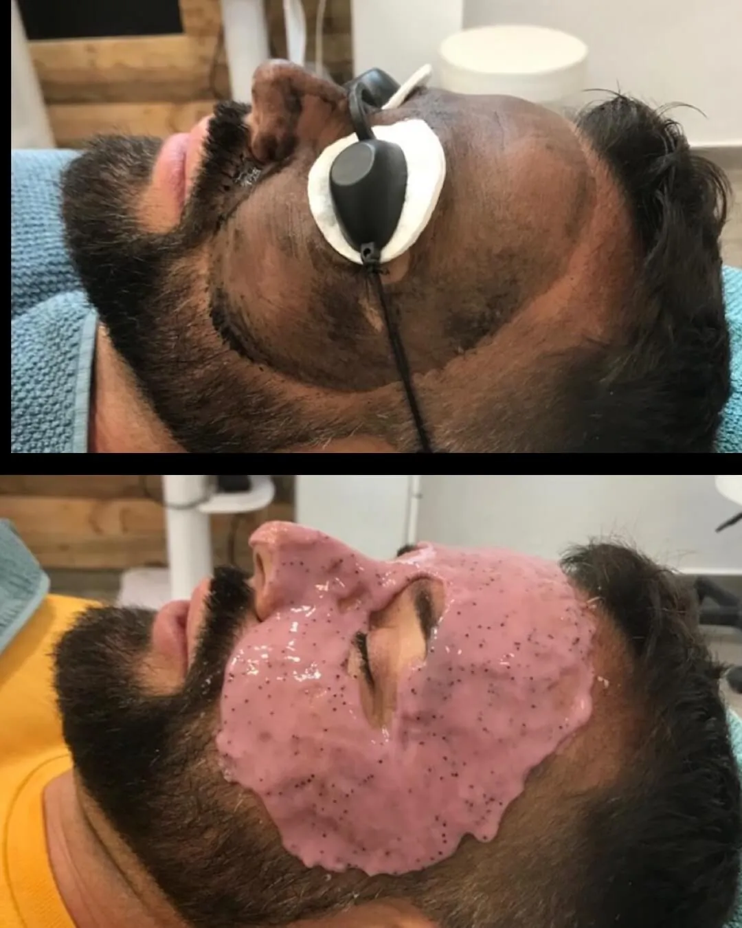 Tratamiento masculino láser para tratar arrugas y limpiar la piel