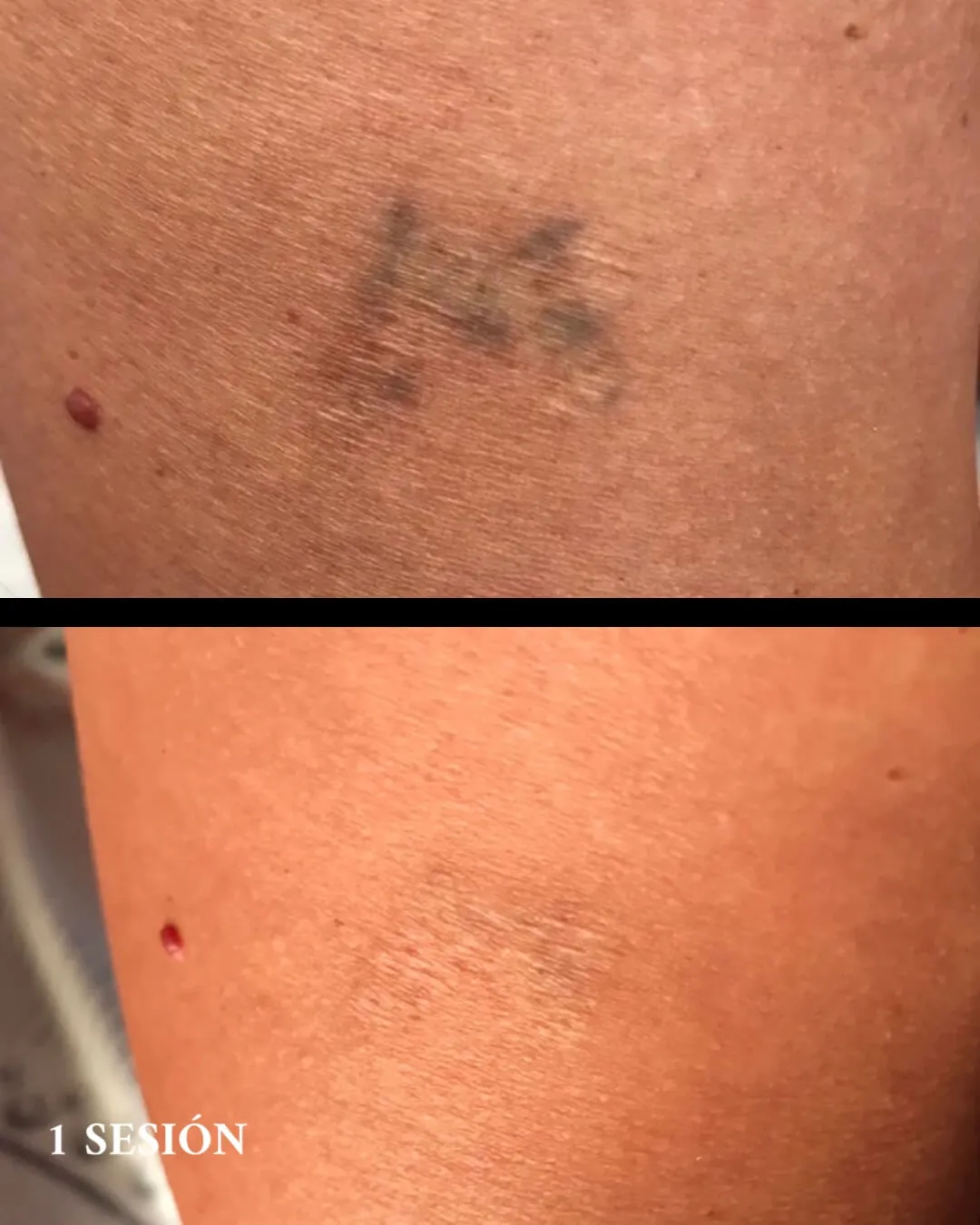 Borrar tatuajes con láser en Valencia