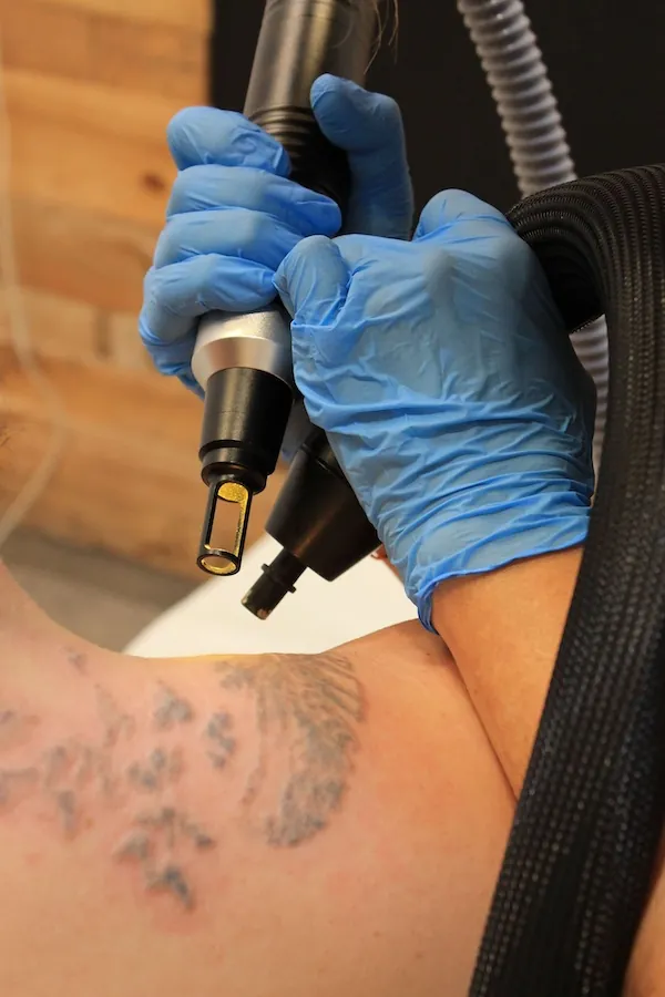 ¿Duele eliminarse un tatuaje?