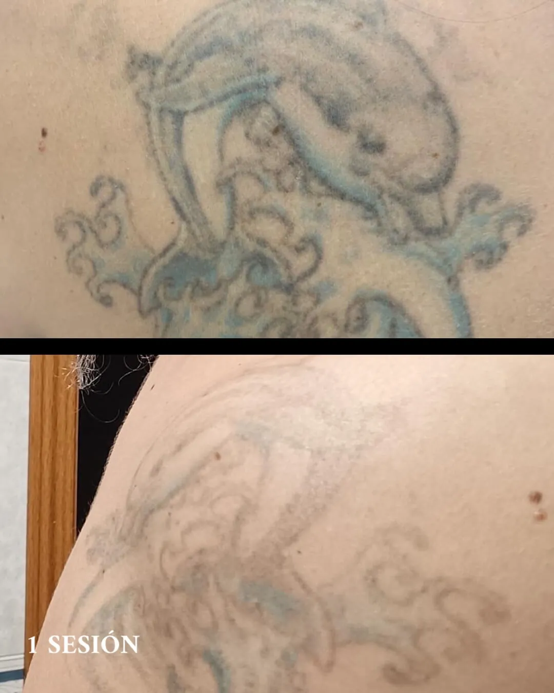 Eliminación tatuajes barato