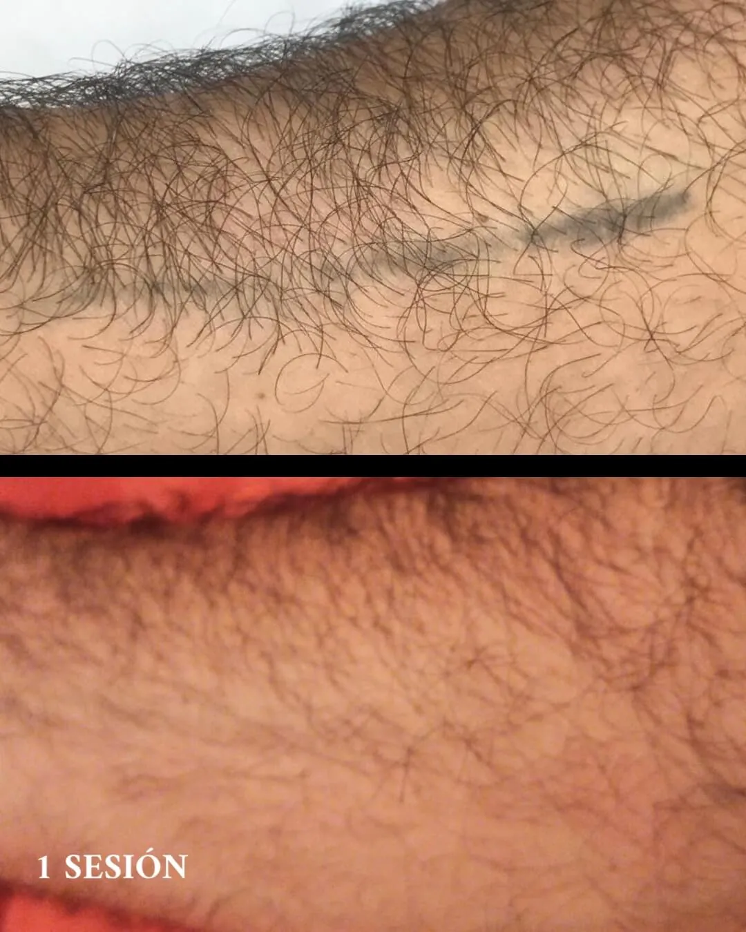 Eliminación tatuajes en Valencia desde la primera sesión