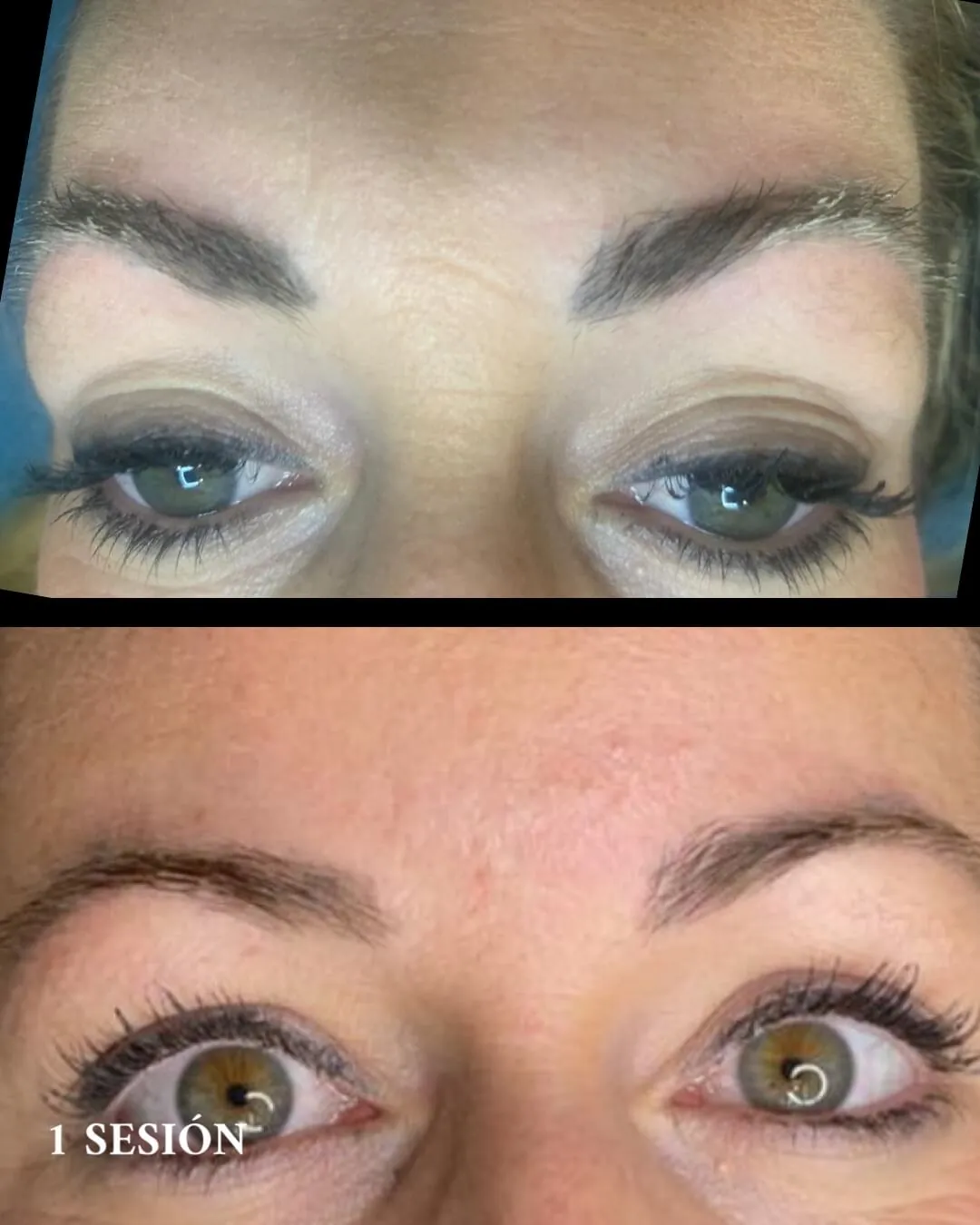 Restos de microblading en las cejas antes y después del láser