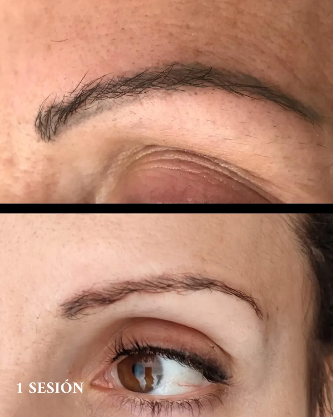 Resultado tras una sesión de láser sobre un microblading antiguo