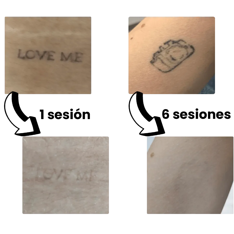 Guía completa de eliminación de tatuajes en valencia