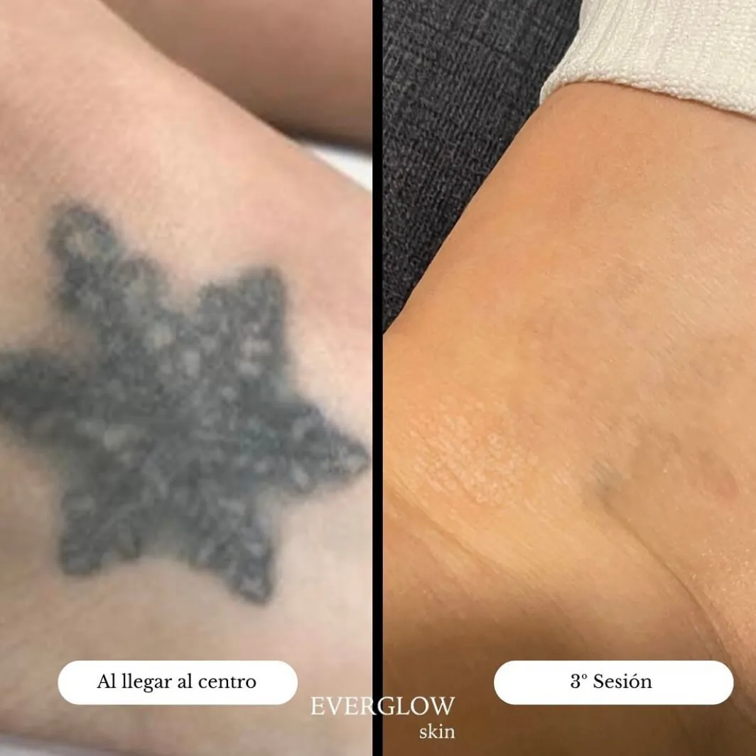 Proceso completo eliminación de tatuajes con tres sesiones
