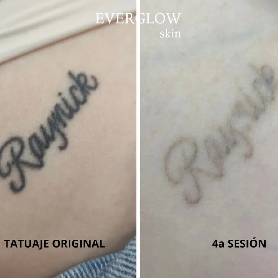 Proceso completo eliminación de tatuajes en Valencia con cuatro sesiones