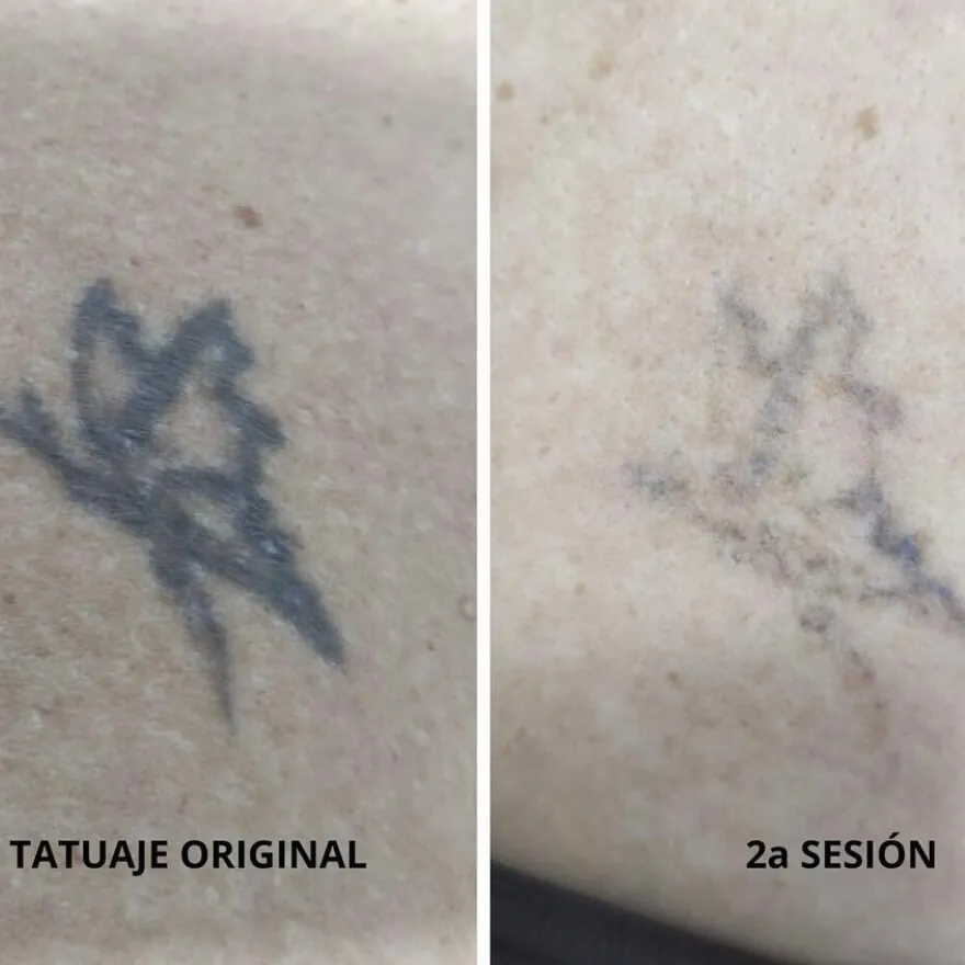 Proceso completo eliminación de tatuajes en Valencia con dos sesiones