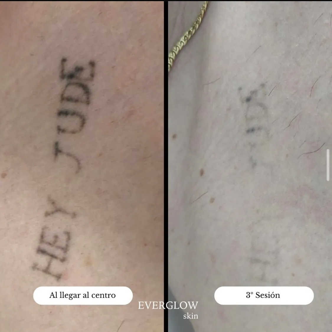 Proceso completo eliminación de tatuajes en Valencia con tres sesiones completas