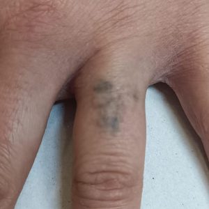 Eliminación tatuaje lazo en el dedo en su segunda sesión