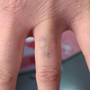Eliminación tatuaje lazo en el dedo en su tercera sesión