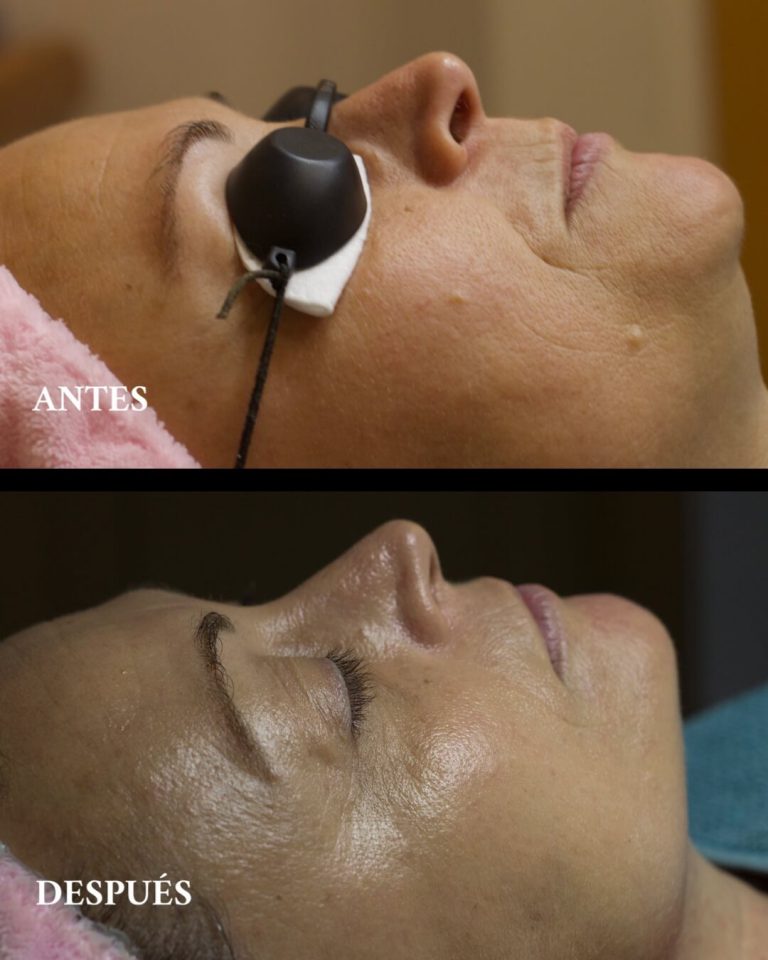 Antes y después tratamiento hidratación facial