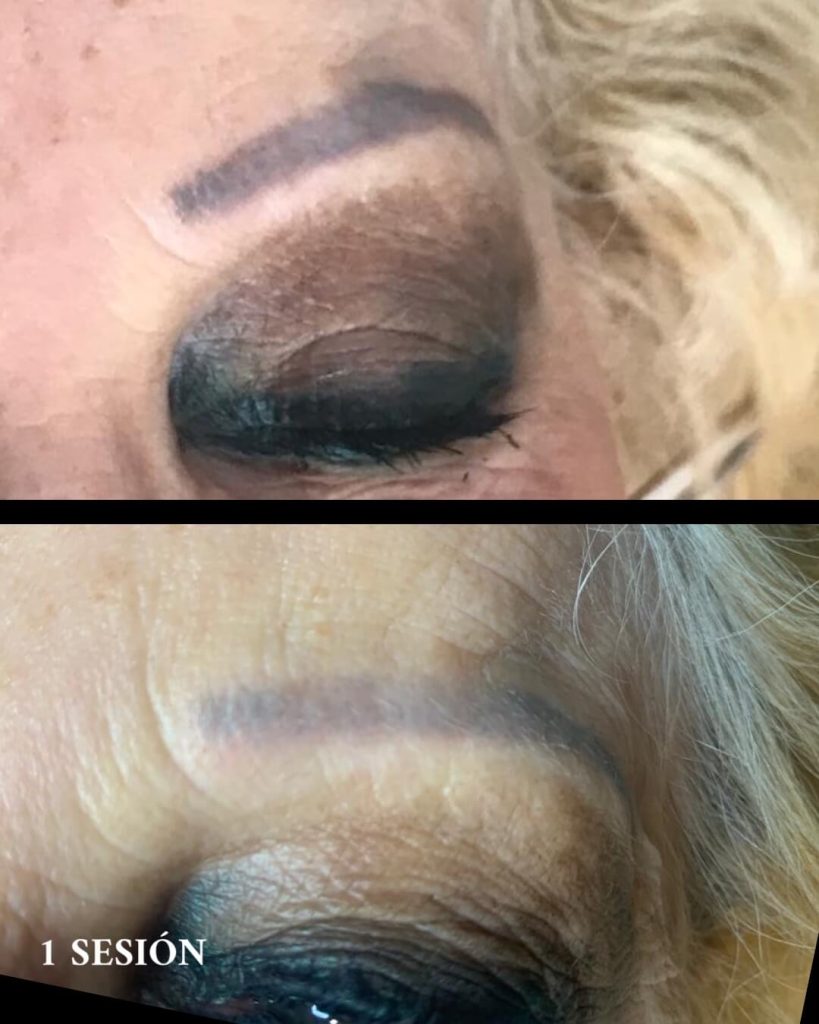 Eliminación micropigmentaciones de cejas en Valencia