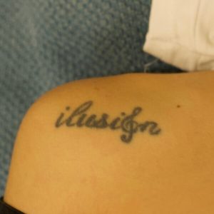 Eliminación tatuaje hombro Andrea Garte
