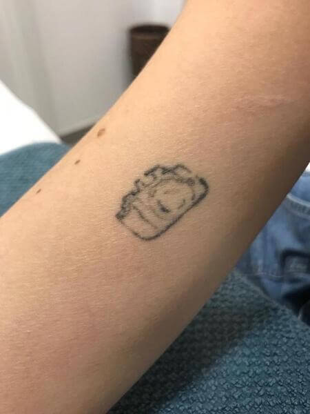 Eliminación de tatuaje Andrea Garte en el brazo