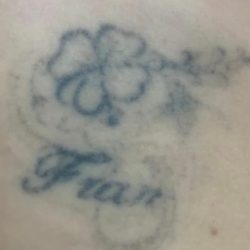Segunda sesión de cliente con tatuaje con nombre de Fran y rosa. Eliminación de tatuajes en Valencia