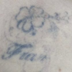 Tercera sesión de cliente con tatuaje con nombre de Fran y rosa. Eliminación de tatuajes en Valencia