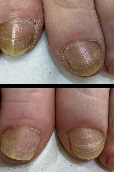 Eliminación hongos de las uñas de los pies con láser