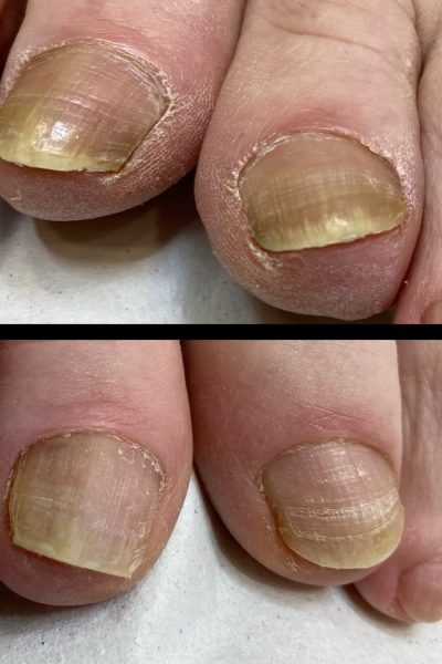 Tratamiento Onicomicosis de las uñas de los pies