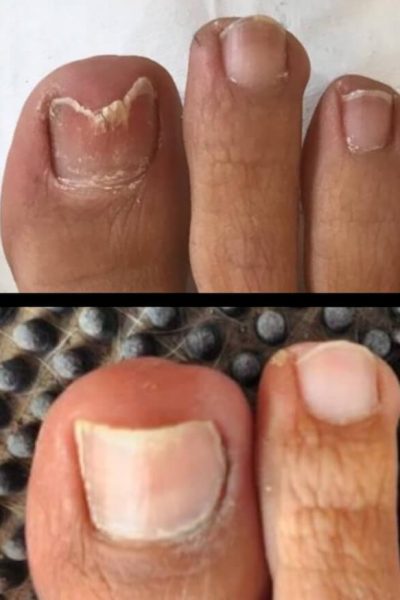 Tratamiento para eliminar los hongos de los pies