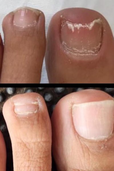 Tratamiento hongos de las uñas de los pies