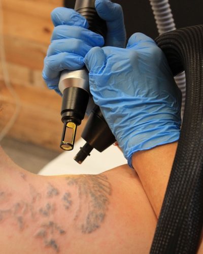 ¿Duele eliminarse un tatuaje?